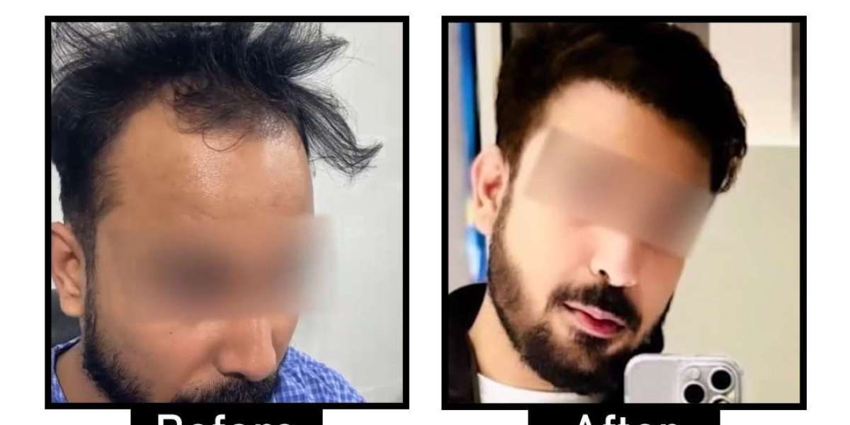 Best Hair Doctor in South Delhi: Expert Solutions for Hair Loss